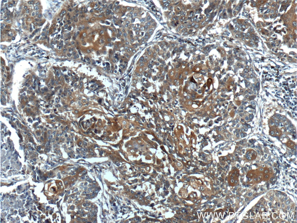 Immunohistochemistry (IHC) staining of human lung cancer tissue using BRCA1 Polyclonal antibody (22362-1-AP)