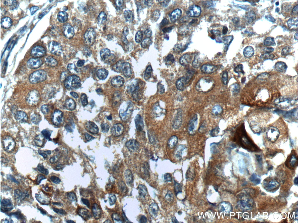 Immunohistochemistry (IHC) staining of human lung cancer tissue using BRCA1 Polyclonal antibody (22362-1-AP)