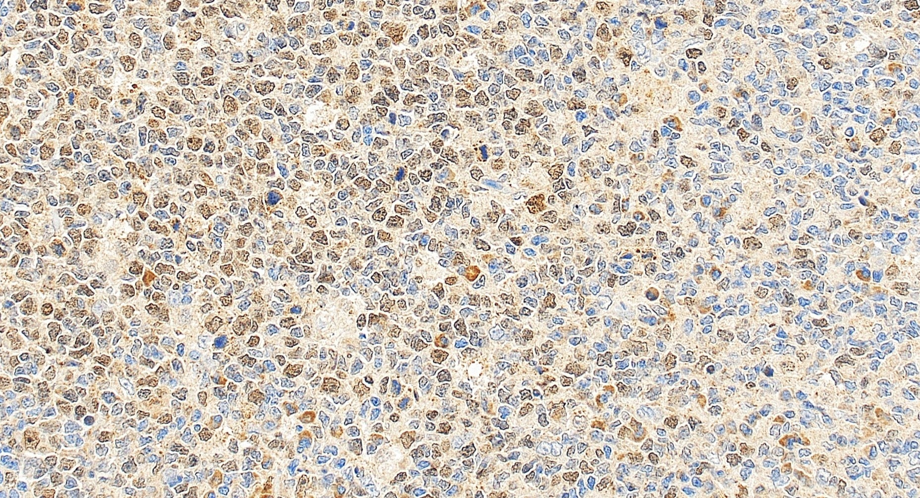 Immunohistochemical analysis of paraffin-embedded human tonsillitis tissue slide using 22362-1-AP (BRCA1 antibody) at dilution of 1:1000 (under 20x lens). Heat mediated antigen retrieval with Tris-EDTA buffer (pH 9.0). Immunohistochemistry (IHC) staining of human tonsillitis tissue using BRCA1 Polyclonal antibody (22362-1-AP)