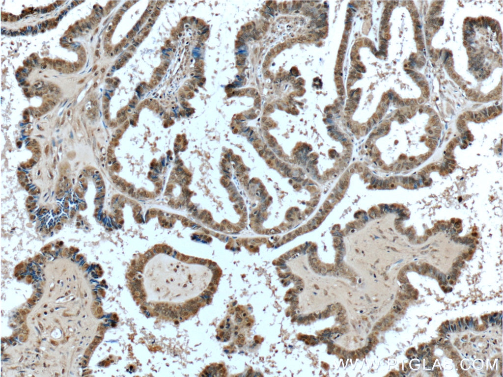 IHC staining of human ovary tumor using 66267-1-Ig