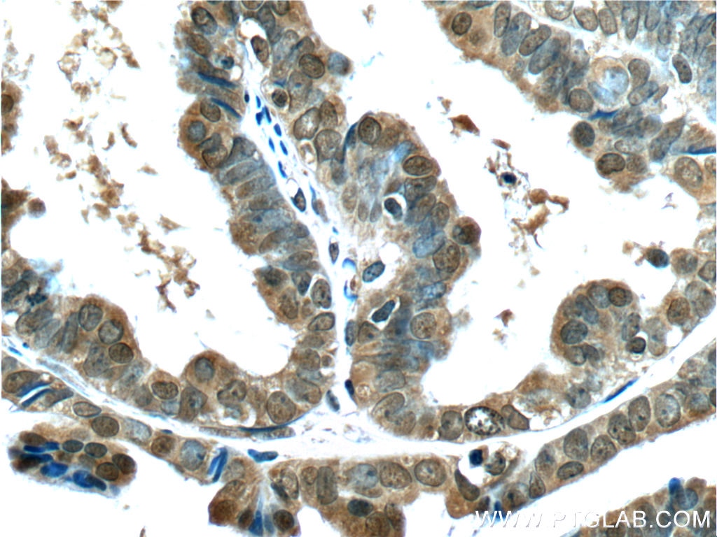 Immunohistochemistry (IHC) staining of human ovary tumor tissue using BRCA1 Monoclonal antibody (66267-1-Ig)