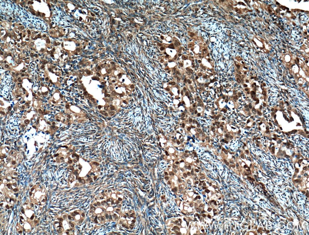 IHC staining of human ovary tumor using 66267-1-Ig