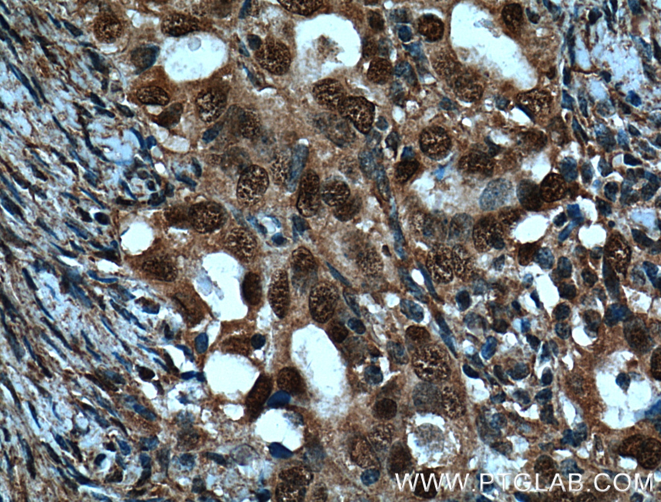 Immunohistochemistry (IHC) staining of human ovary tumor tissue using BRCA1 Monoclonal antibody (66267-1-Ig)