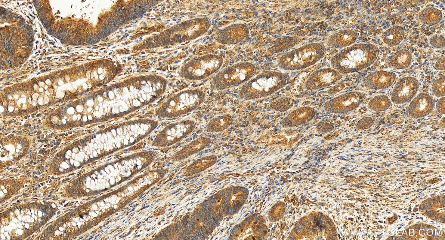 Immunohistochemistry (IHC) staining of human colon cancer tissue using BRCA2 Polyclonal antibody (29450-1-AP)