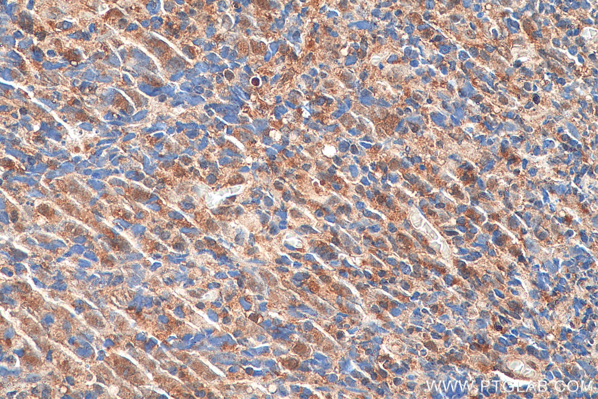 Immunohistochemistry (IHC) staining of human nasopharyngeal carcinoma tissue using BRCC3 Polyclonal antibody (15391-1-AP)
