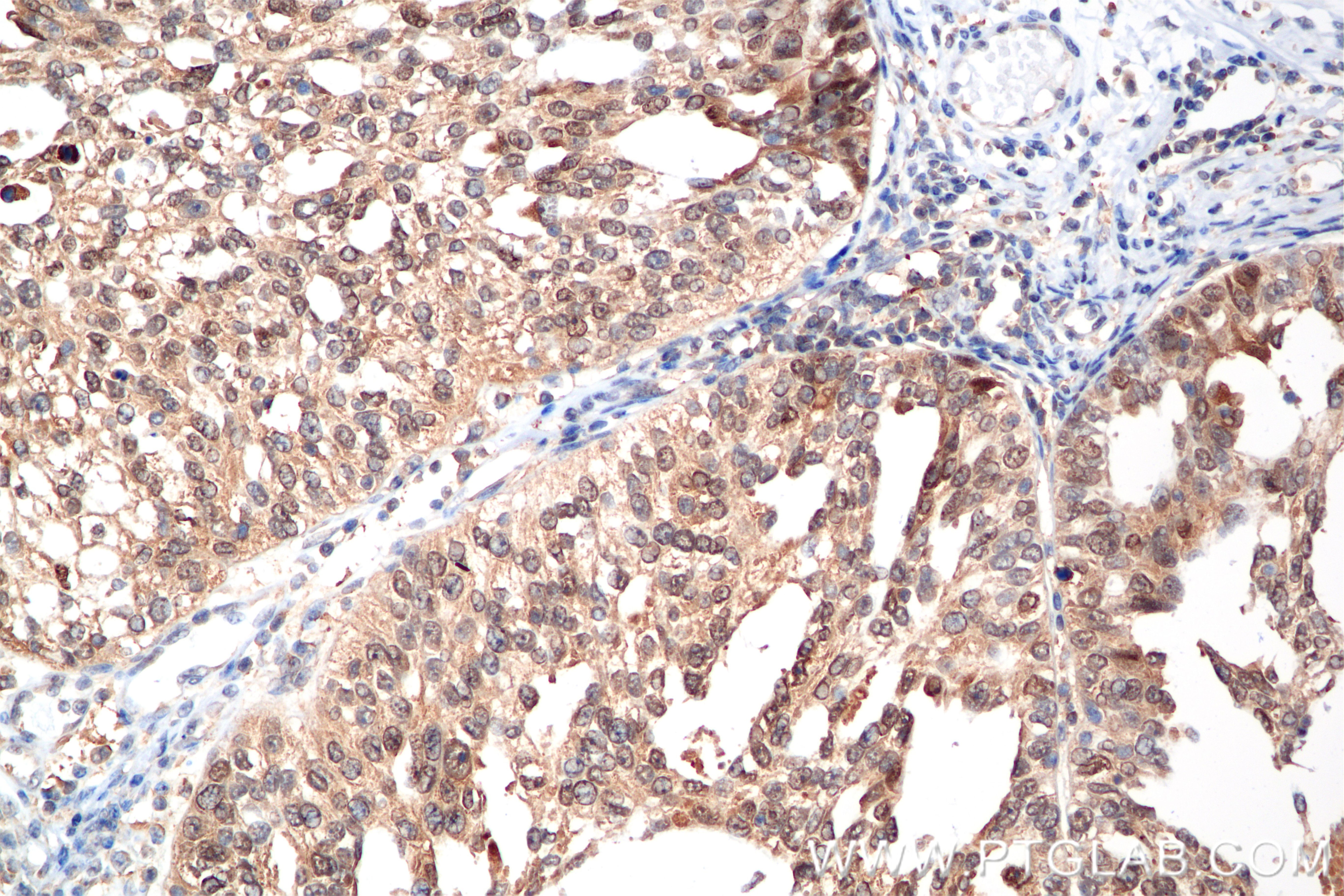 Immunohistochemistry (IHC) staining of human ovary cancer tissue using BRCC3 Recombinant antibody (85430-4-RR)