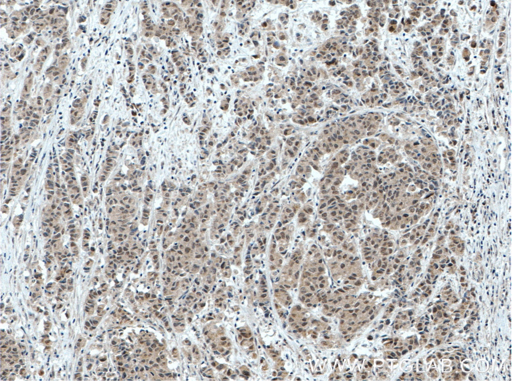 Immunohistochemistry (IHC) staining of human prostate cancer tissue using BRD3 Polyclonal antibody (11859-1-AP)