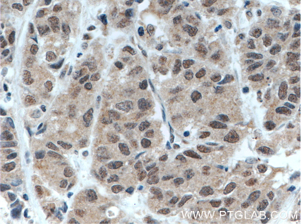 Immunohistochemistry (IHC) staining of human prostate cancer tissue using BRD3 Polyclonal antibody (11859-1-AP)