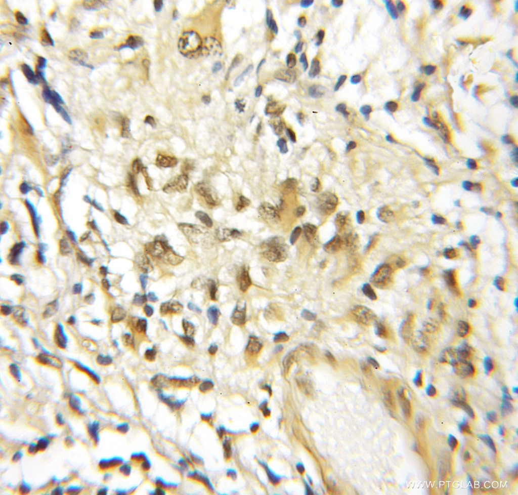 Immunohistochemistry (IHC) staining of human gliomas tissue using BRD3 Polyclonal antibody (11859-1-AP)