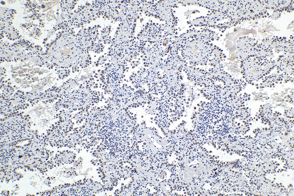 Immunohistochemistry (IHC) staining of human lung cancer tissue using BRD4 Polyclonal antibody (28486-1-AP)