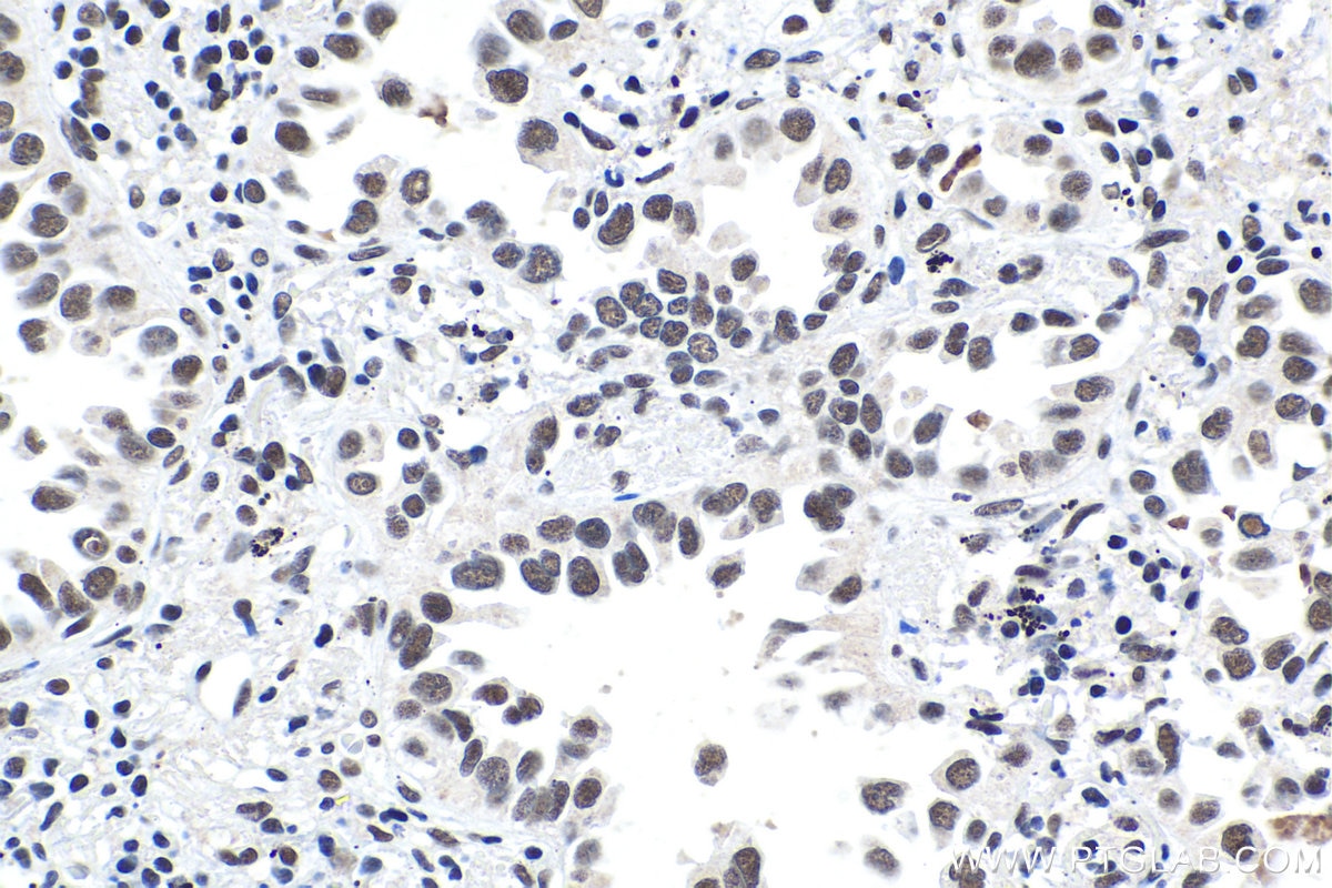 Immunohistochemistry (IHC) staining of human lung cancer tissue using BRD4 Polyclonal antibody (28486-1-AP)
