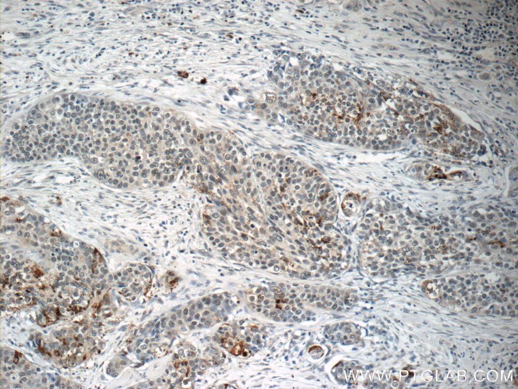 Immunohistochemistry (IHC) staining of human cervical cancer tissue using BRD7 Polyclonal antibody (51009-2-AP)