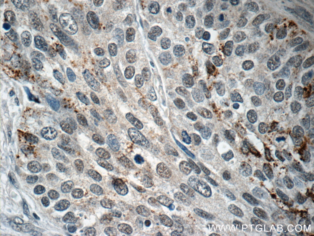 IHC staining of human cervical cancer using 51009-2-AP