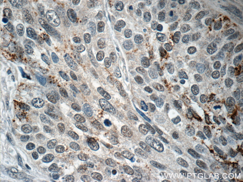 Immunohistochemistry (IHC) staining of human cervical cancer tissue using BRD7 Polyclonal antibody (51009-2-AP)