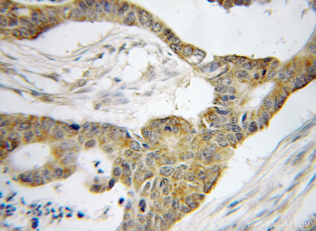 Immunohistochemistry (IHC) staining of human colon cancer tissue using BRD7 Polyclonal antibody (51009-2-AP)