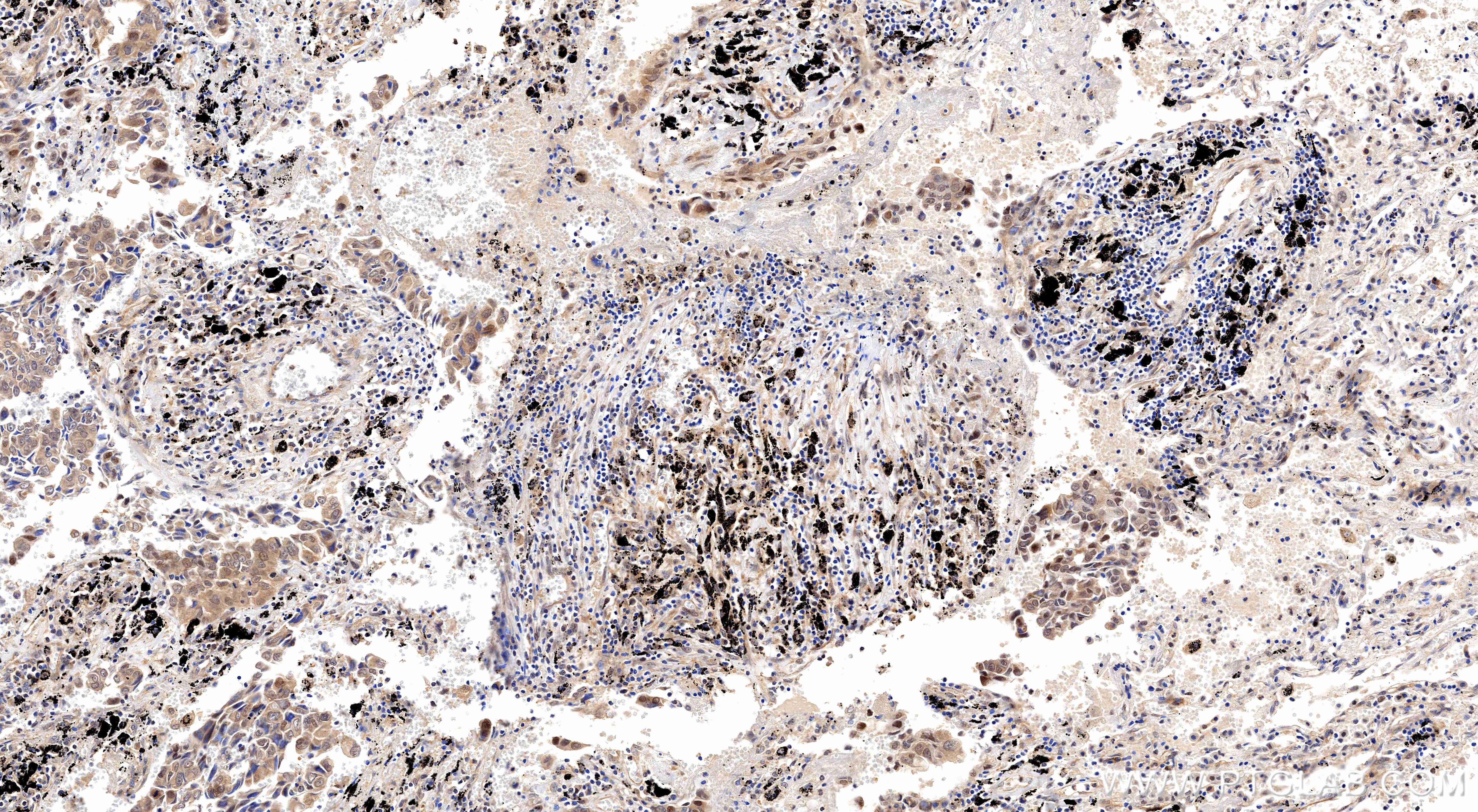 Immunohistochemistry (IHC) staining of human lung cancer tissue using BRD7 Recombinant monoclonal antibody (86176-2-RR)