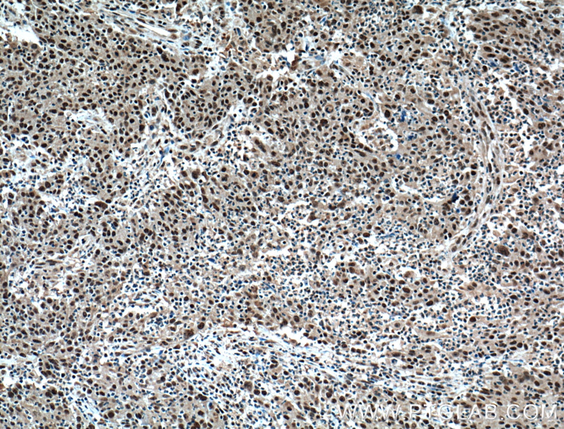 IHC staining of human colon cancer using 60121-1-Ig