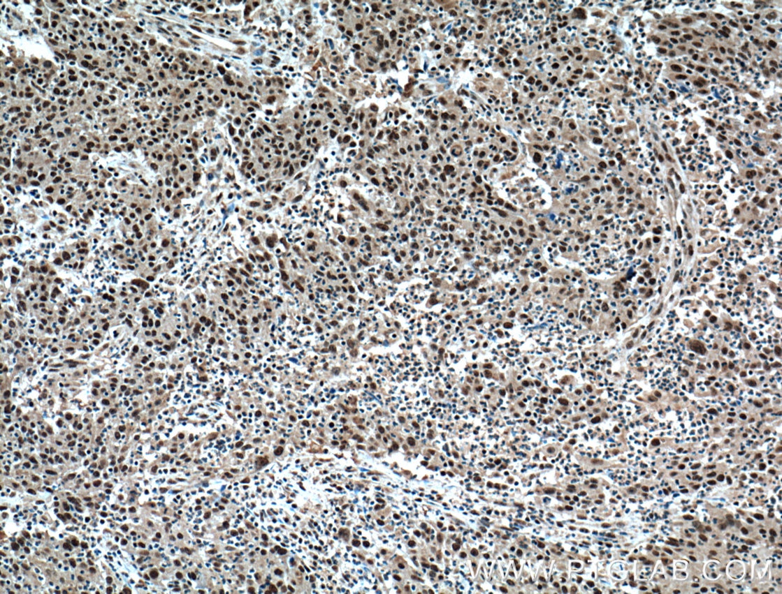 Immunohistochemistry (IHC) staining of human colon cancer tissue using BRD8 Monoclonal antibody (60121-1-Ig)