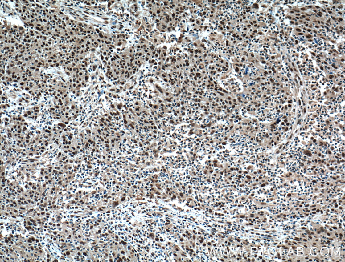 Immunohistochemistry (IHC) staining of human colon cancer tissue using BRD8 Monoclonal antibody (60121-1-Ig)