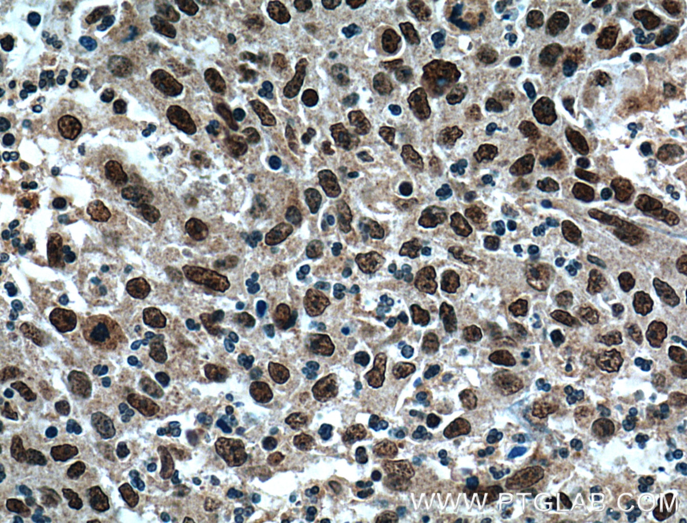 Immunohistochemistry (IHC) staining of human colon cancer tissue using BRD8 Monoclonal antibody (60121-1-Ig)