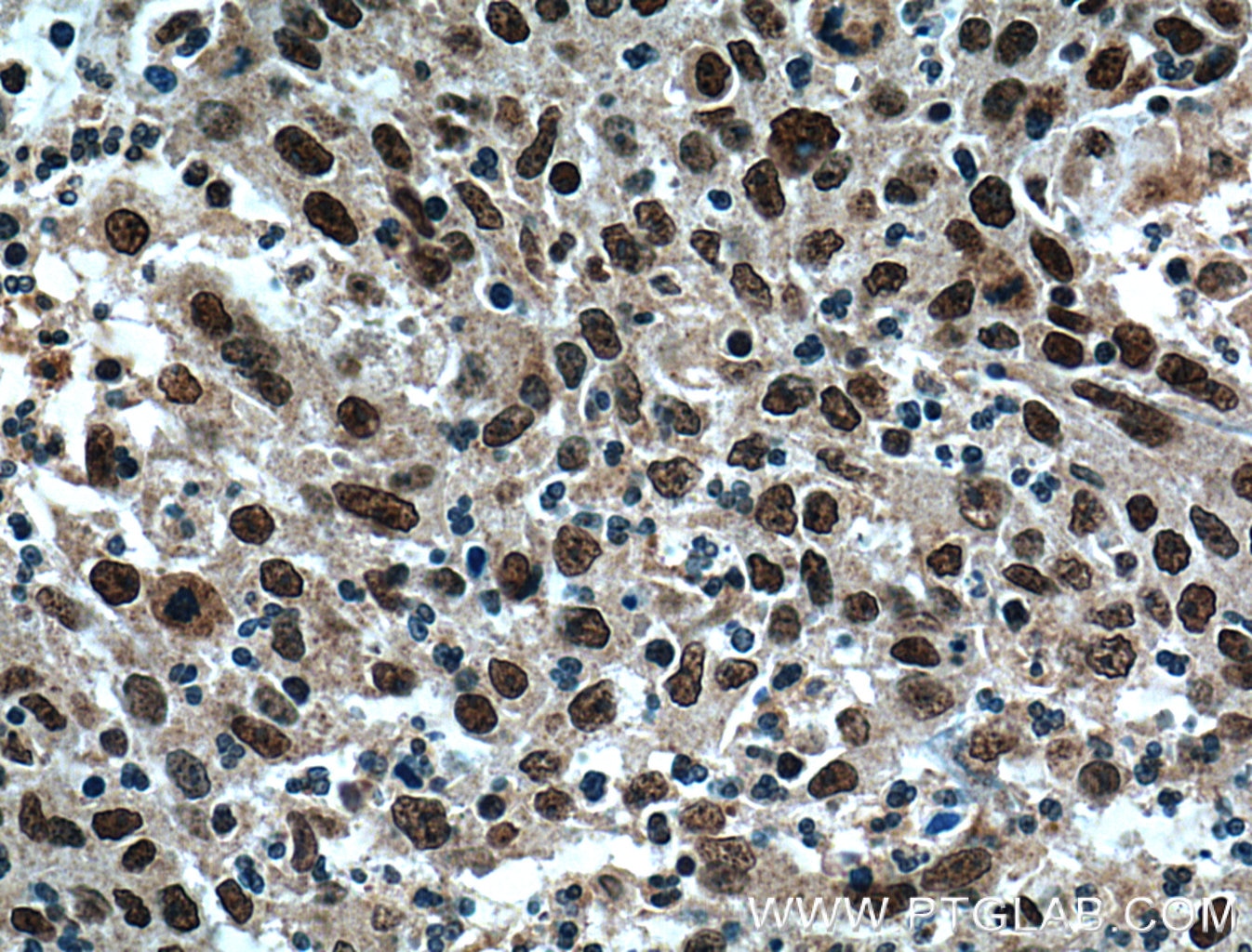 IHC staining of human colon cancer using 60121-1-Ig