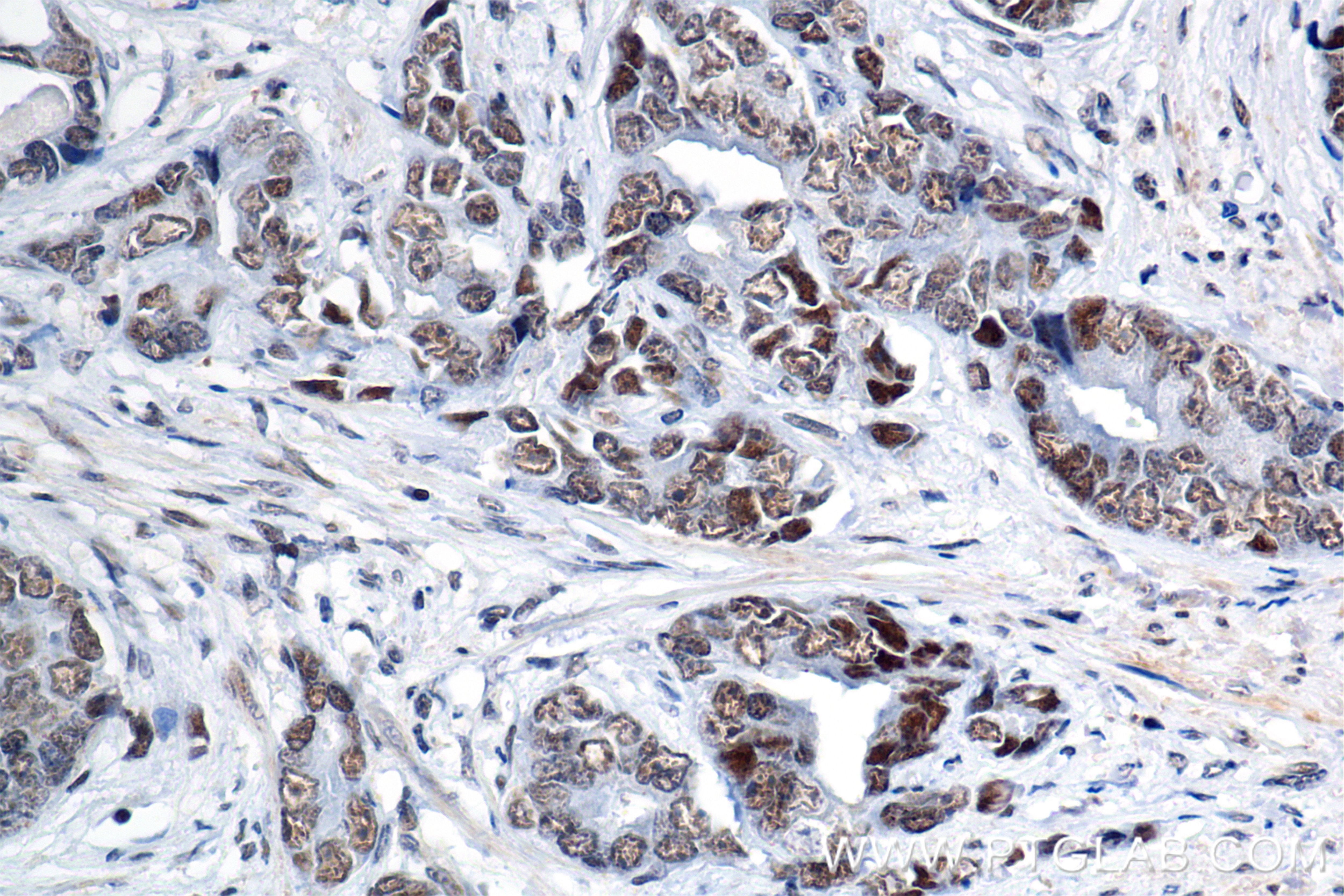 Immunohistochemistry (IHC) staining of human prostate cancer tissue using BRD8 Recombinant antibody (84965-1-RR)