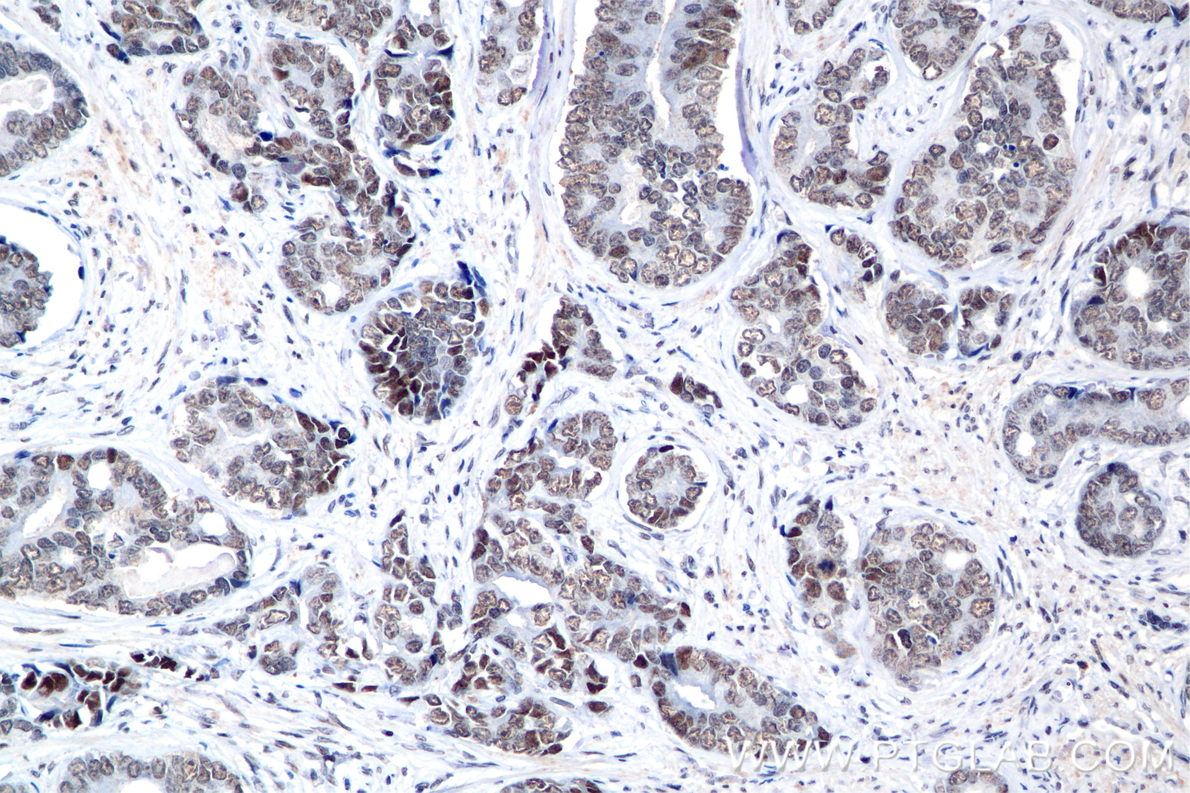 Immunohistochemistry (IHC) staining of human prostate cancer tissue using BRD8 Recombinant antibody (84965-1-RR)