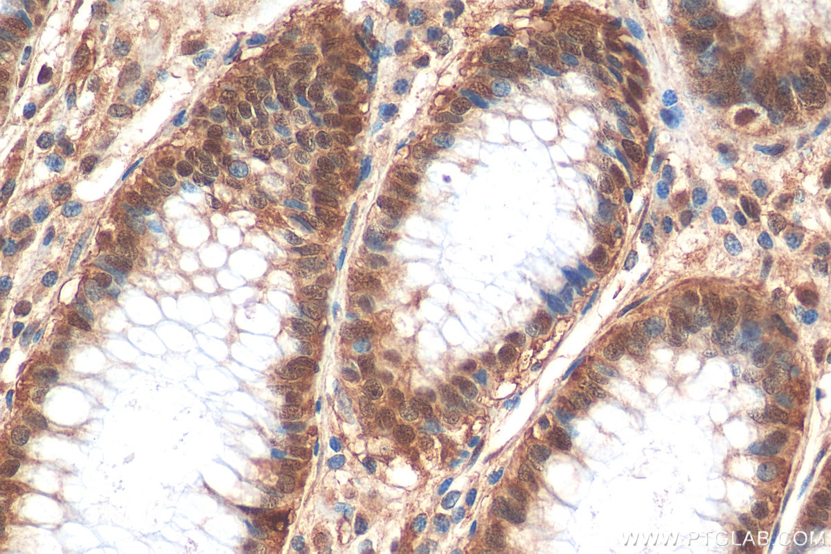 Immunohistochemistry (IHC) staining of human colon cancer tissue using BRD9 Polyclonal antibody (24785-1-AP)