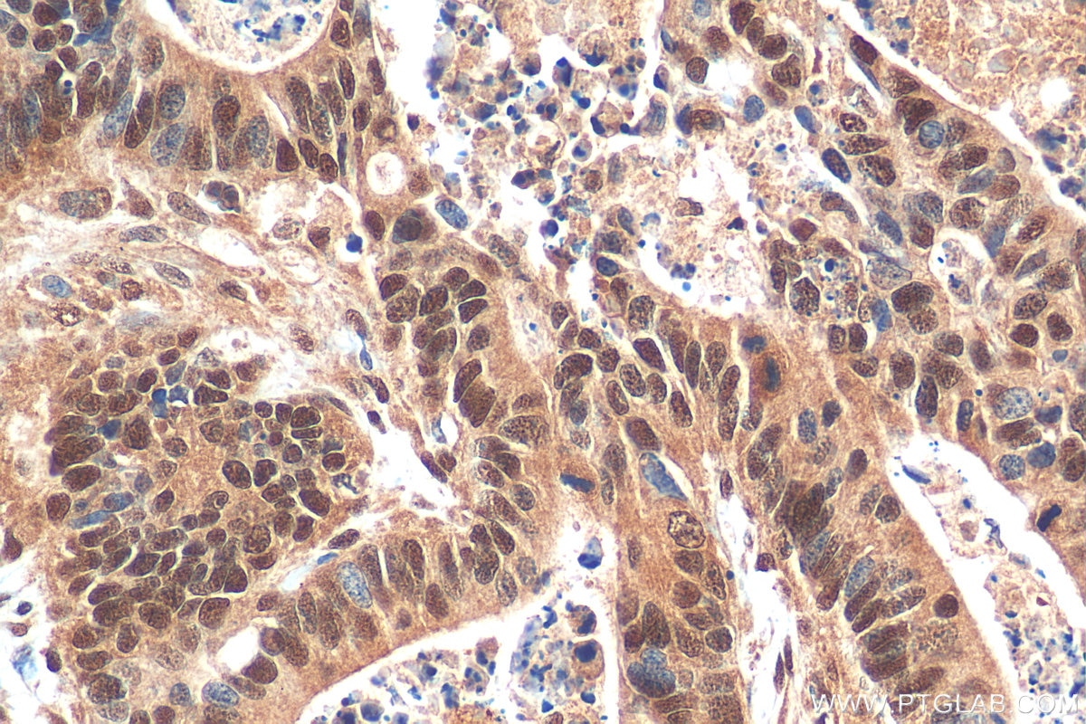 Immunohistochemistry (IHC) staining of human colon cancer tissue using BRD9 Polyclonal antibody (24785-1-AP)