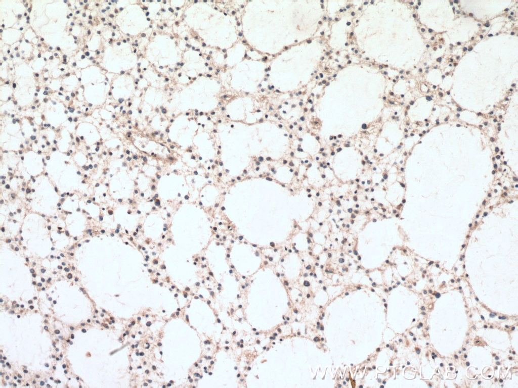 Immunohistochemistry (IHC) staining of human gliomas tissue using BRE Polyclonal antibody (11702-1-AP)