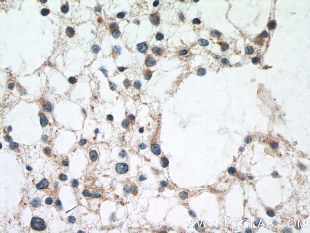 Immunohistochemistry (IHC) staining of human gliomas tissue using BRE Polyclonal antibody (11702-1-AP)