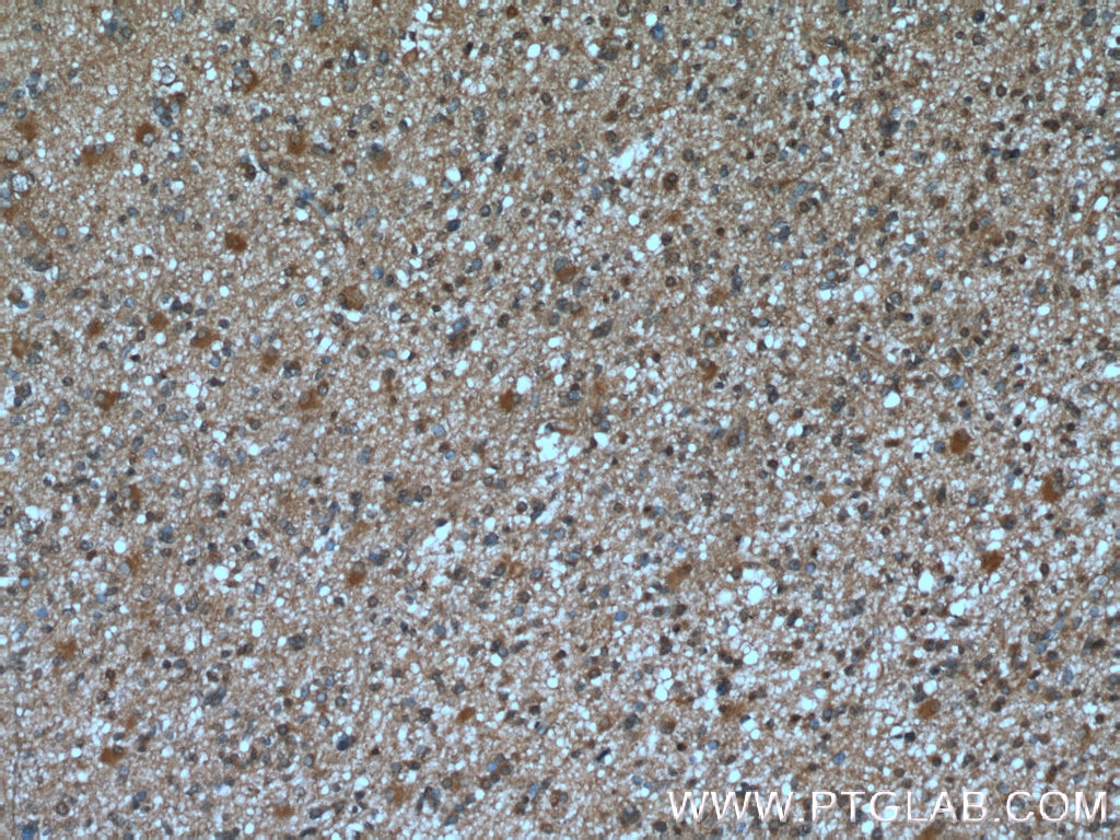 IHC staining of human gliomas using 66356-1-Ig