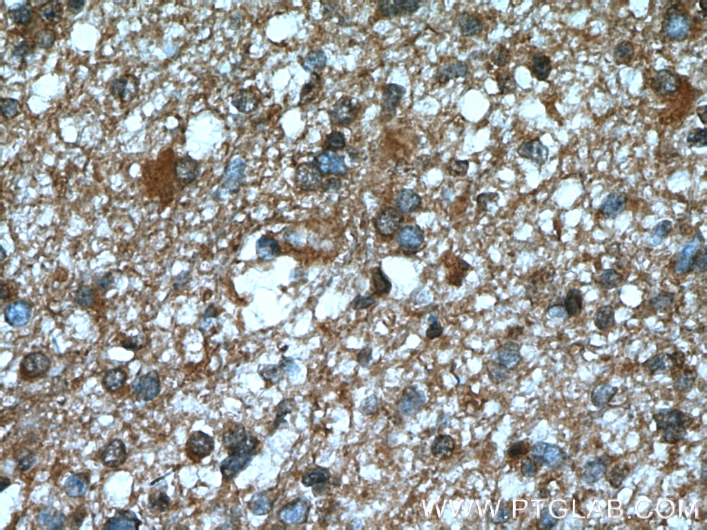 Immunohistochemistry (IHC) staining of human gliomas tissue using BRE Monoclonal antibody (66356-1-Ig)