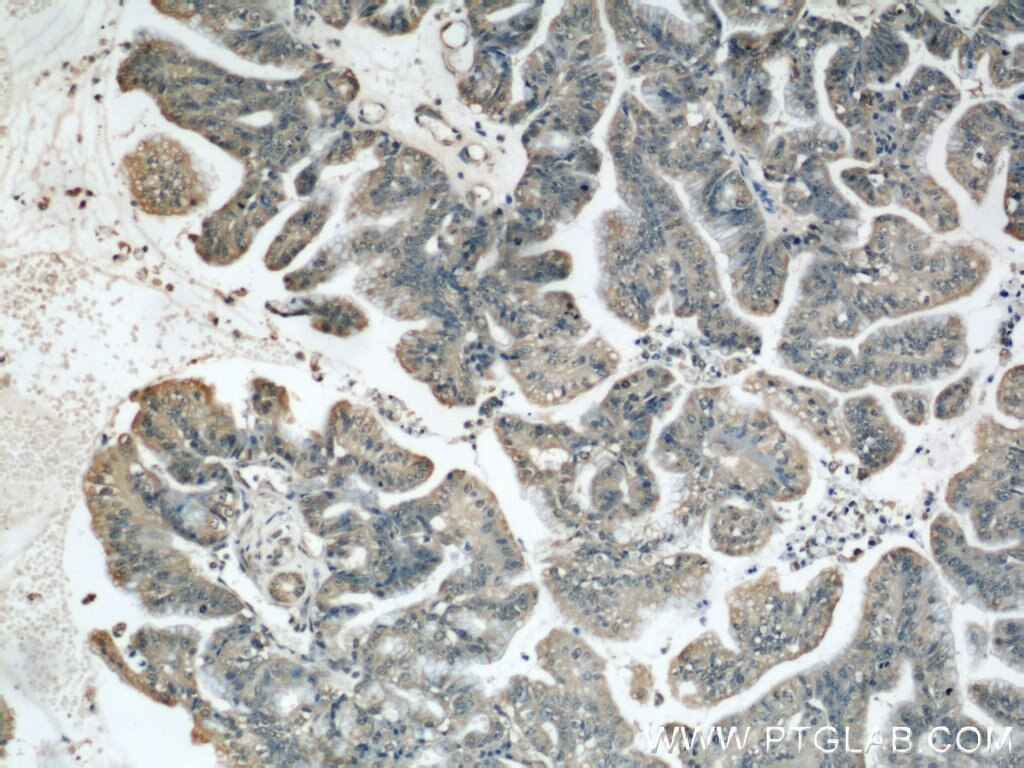 Immunohistochemistry (IHC) staining of human ovary tumor tissue using BRIP1(C-terminal) Polyclonal antibody (20983-1-AP)