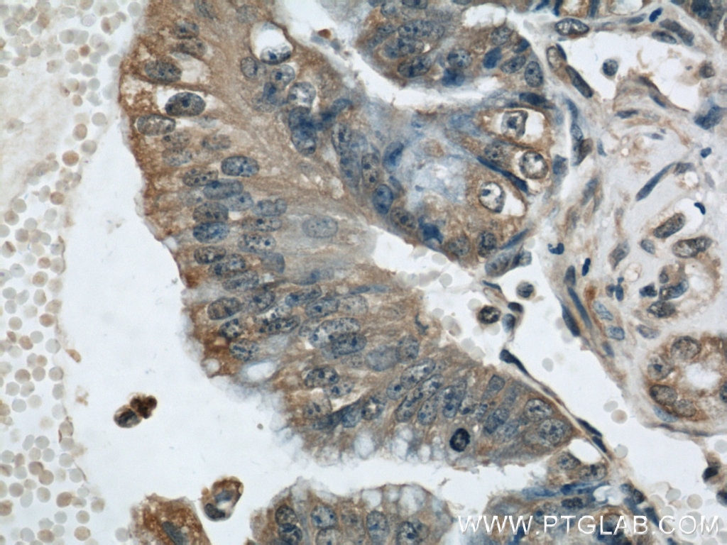 Immunohistochemistry (IHC) staining of human ovary tumor tissue using BRIP1(C-terminal) Polyclonal antibody (20983-1-AP)