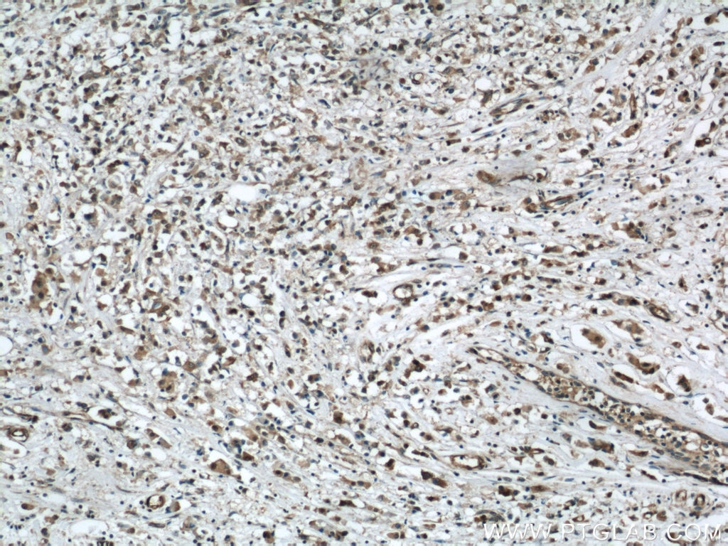 Immunohistochemistry (IHC) staining of human breast cancer tissue using BRIP1(C-terminal) Polyclonal antibody (20983-1-AP)