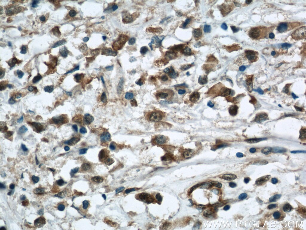 Immunohistochemistry (IHC) staining of human breast cancer tissue using BRIP1(C-terminal) Polyclonal antibody (20983-1-AP)