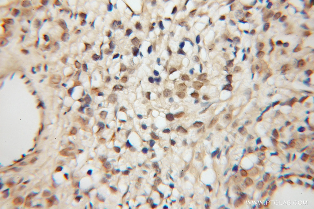 Immunohistochemistry (IHC) staining of human prostate cancer tissue using MCPH/BRIT1 Polyclonal antibody (11962-1-AP)