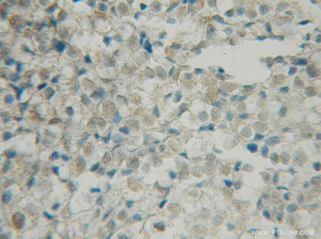 Immunohistochemistry (IHC) staining of human ovary tumor tissue using BRSK1 Polyclonal antibody (12673-1-AP)