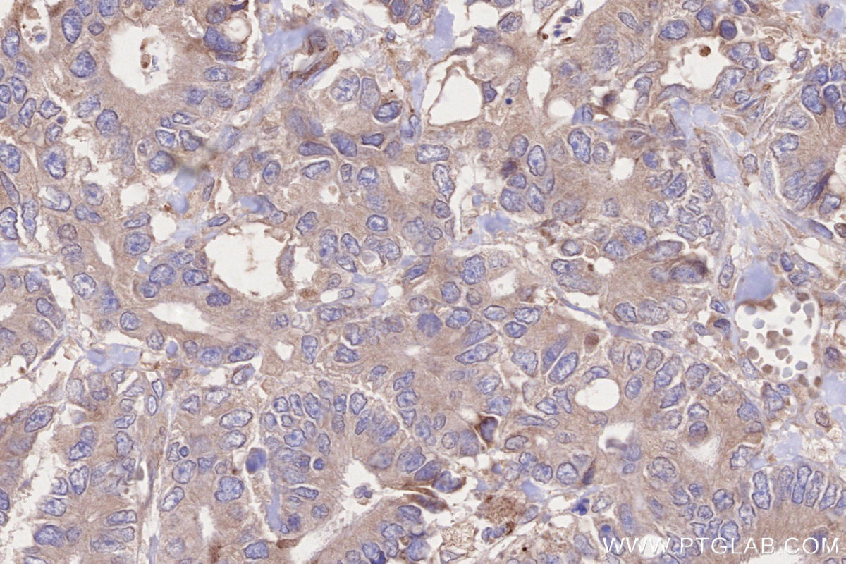 Immunohistochemistry (IHC) staining of human rectal cancer tissue using BRSK2 Polyclonal antibody (11589-1-AP)