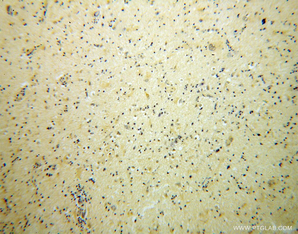 Immunohistochemistry (IHC) staining of human gliomas tissue using BRUNOL5 Polyclonal antibody (13557-1-AP)