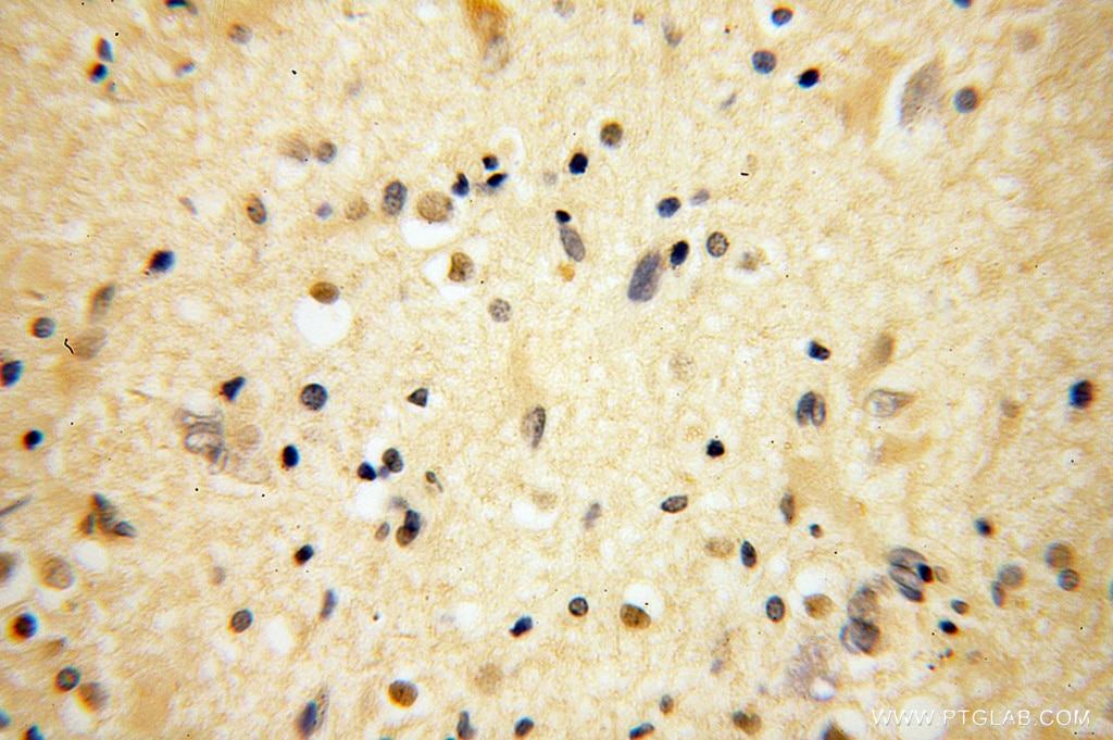 Immunohistochemistry (IHC) staining of human gliomas tissue using BRUNOL5 Polyclonal antibody (13557-1-AP)