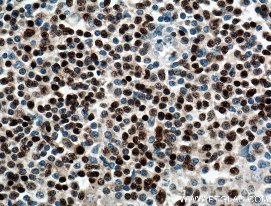 Immunohistochemistry (IHC) staining of human lymphoma tissue using BSAP,PAX5 Polyclonal antibody (26709-1-AP)