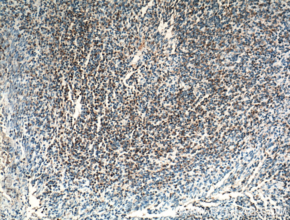 Immunohistochemistry (IHC) staining of human tonsillitis tissue using BSAP,PAX5 Polyclonal antibody (26709-1-AP)