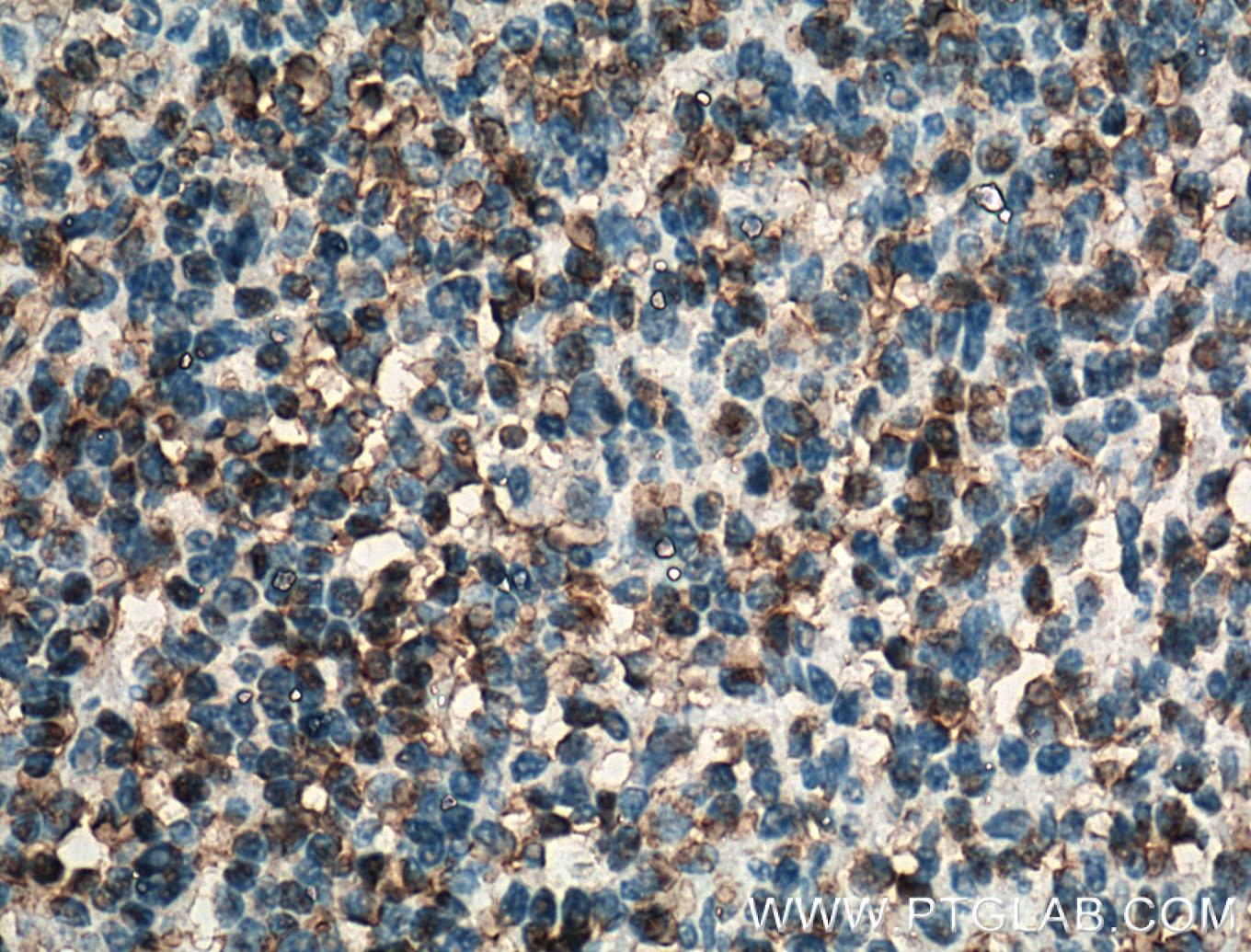 Immunohistochemistry (IHC) staining of human tonsillitis tissue using BSAP,PAX5 Polyclonal antibody (26709-1-AP)
