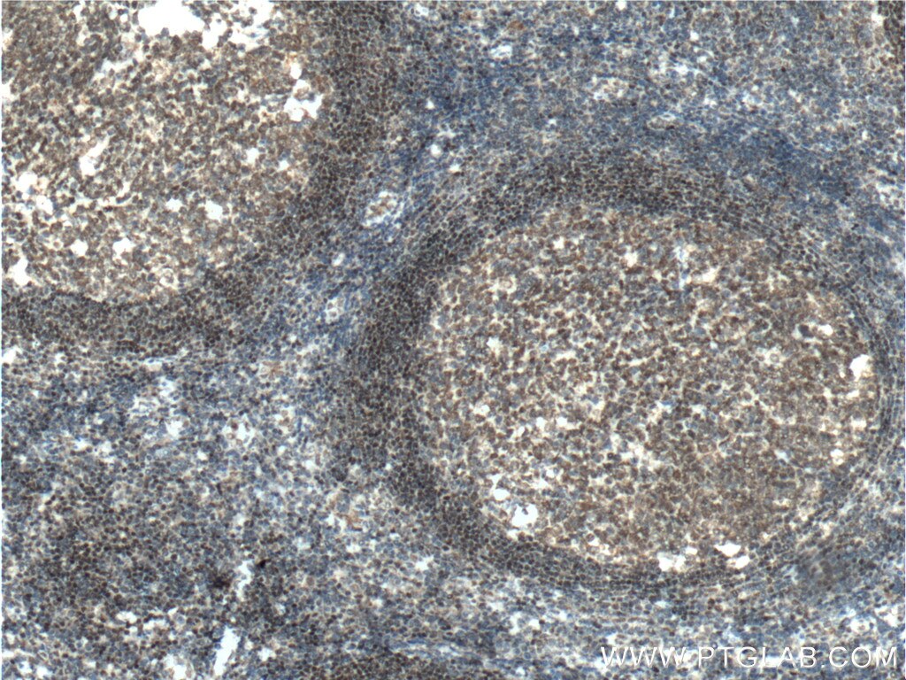 IHC staining of human tonsillitis using 60349-1-Ig