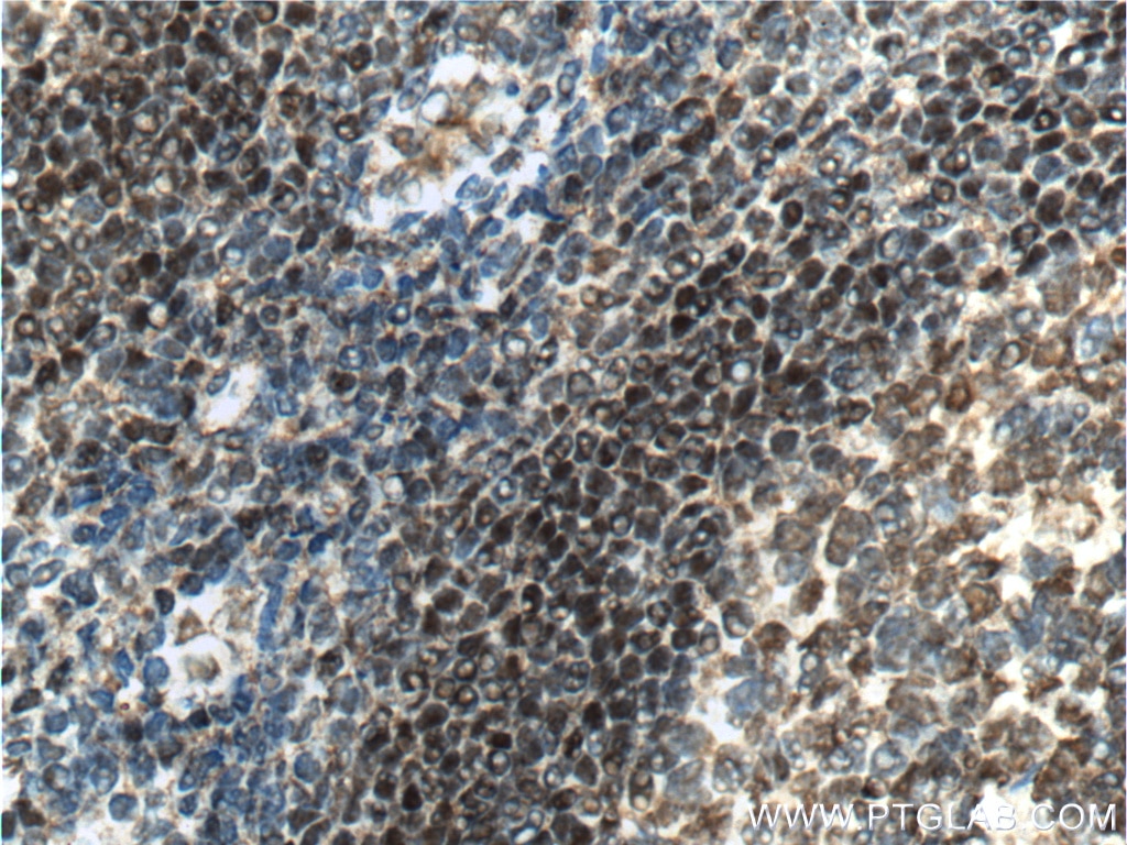 Immunohistochemistry (IHC) staining of human tonsillitis tissue using BSAP,PAX5 Monoclonal antibody (60349-1-Ig)