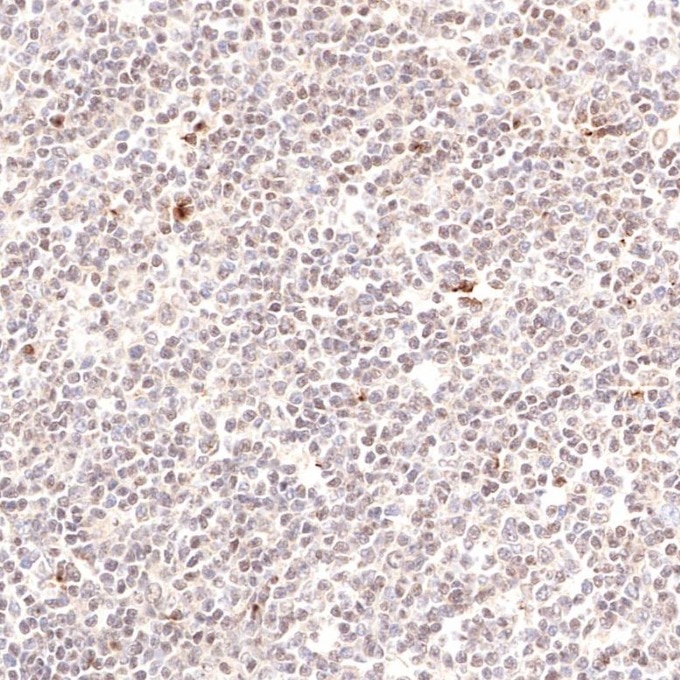 Immunohistochemistry (IHC) staining of human lymphoma tissue using PAX5 Monoclonal antibody (60349-1-Ig)