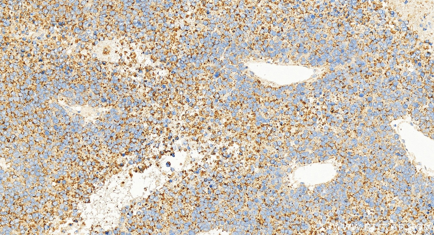 Immunohistochemical analysis of paraffin-embedded human hepatocellular carcinoma slide using 67512-1-Ig (BSEP antibody) at dilution of 1:16000 (under 20x lens). Heat mediated antigen retrieval with Tris-EDTA buffer (pH 9.0). This data was developed using the same antibody clone with 67512-1-PBS in a different storage buffer formulation. Immunohistochemistry (IHC) staining of human hepatocellular carcinoma using BSEP Monoclonal antibody (67512-1-Ig)