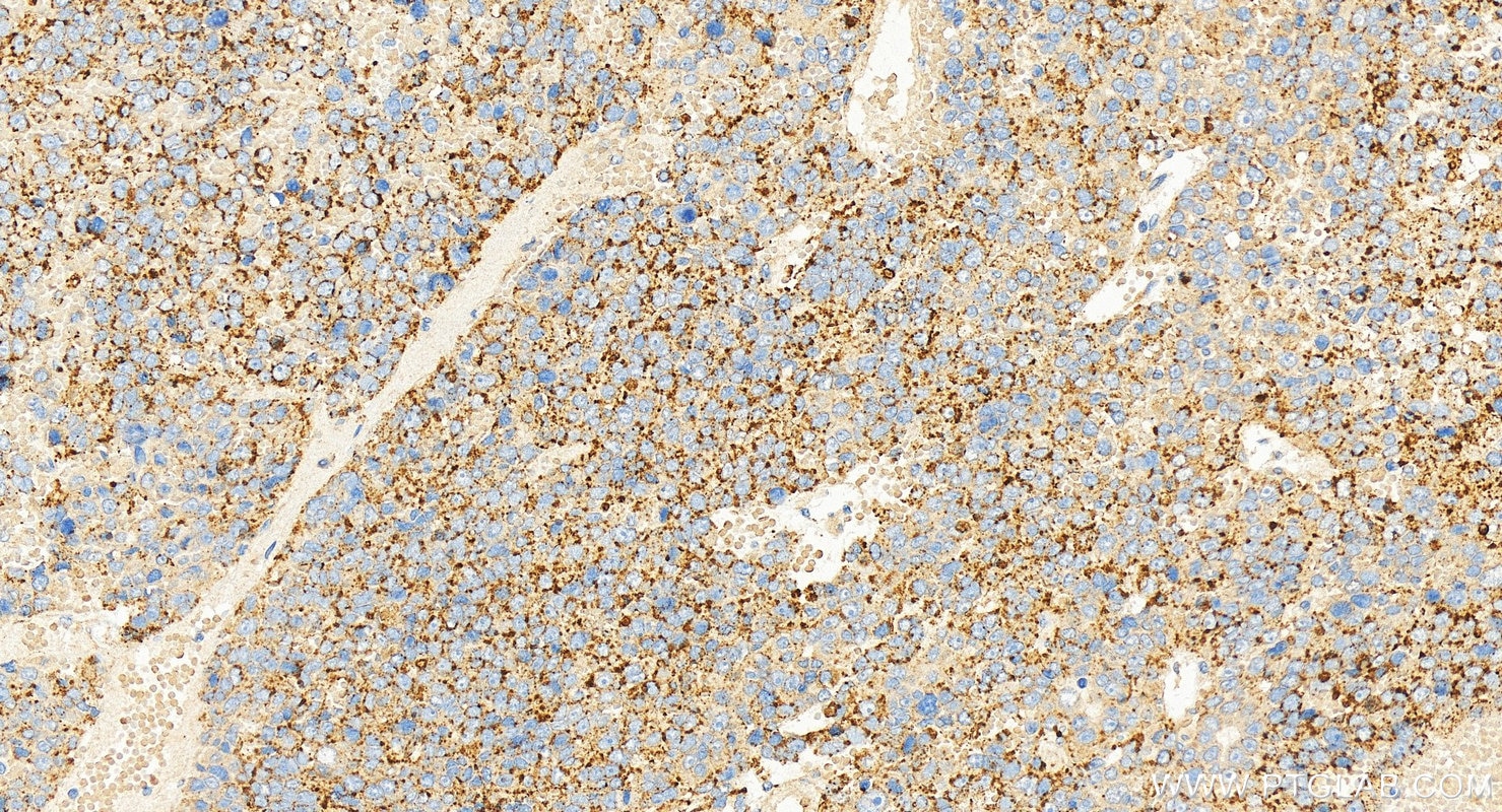 Immunohistochemical analysis of paraffin-embedded human hepatocellular carcinoma slide using 67512-1-Ig (BSEP antibody) at dilution of 1:16000 (under 20x lens). Heat mediated antigen retrieval with Tris-EDTA buffer (pH 9.0). This data was developed using the same antibody clone with 67512-1-PBS in a different storage buffer formulation. Immunohistochemistry (IHC) staining of human hepatocellular carcinoma using BSEP Monoclonal antibody (67512-1-Ig)